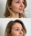 Результати процедури Dermadrop TDA