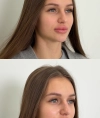 Результати процедури Dermadrop TDA