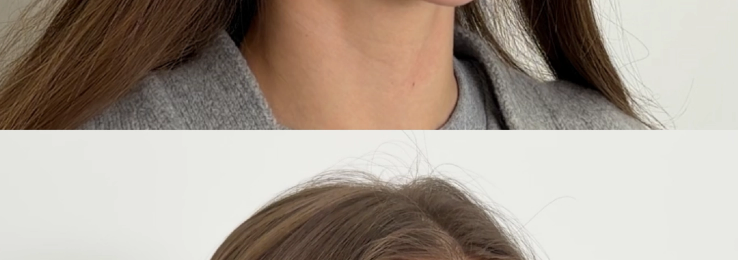 Результати процедури Dermadrop TDA