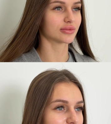 Результати процедури Dermadrop TDA
