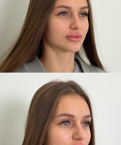 Результати процедури Dermadrop TDA